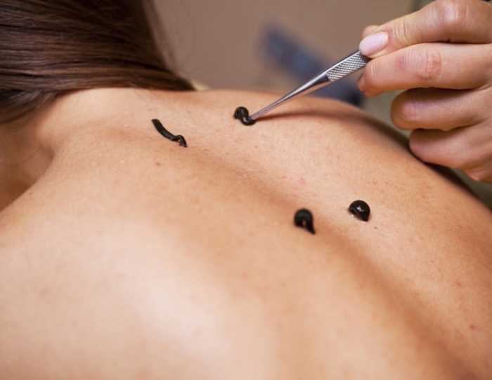 Гирудотерапия - Оздоровительные услуги - Санаторий «Здоровье» Железноводск